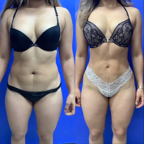 Before and after photo of Liposuction with BodyTite