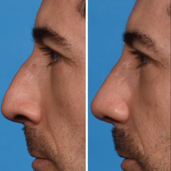 before and after rhinoplasty