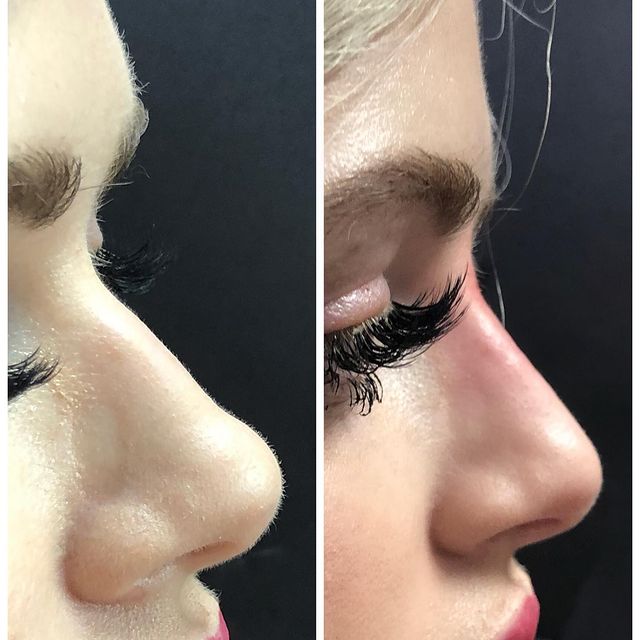 before and after liquidrhinoplasty