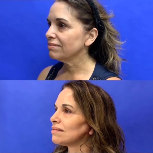 A mini-face & necklift before/after photo