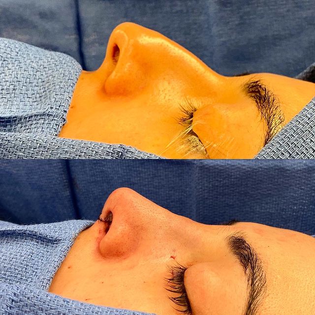 before and after rhinoplasty