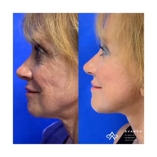 before and after pphotos after radiofrequency technology to resurface & tighten her skin in combination with a mini facelift to further improve her facial contour