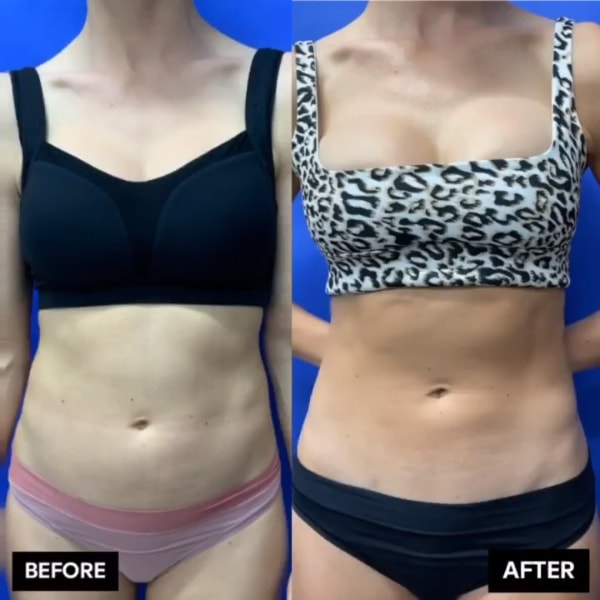 Before and after Ultrasound assisted liposuction & radiofrequency technology work