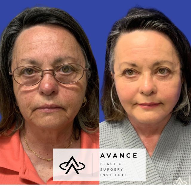Beofre and after photos of 65 years young patient after facelift, fat transfer and chemical peel