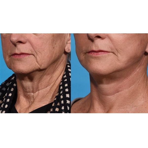 before and after 1 week after a lower facelift & necklift