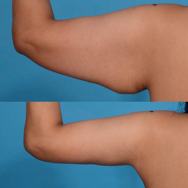 before and after 4 weeks after her arm lift looking
