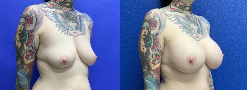 Before and After - Breast Augmentation