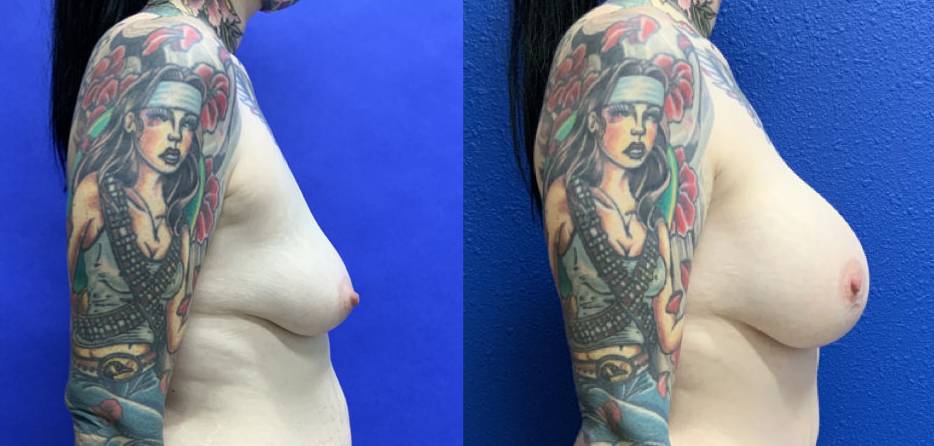 Before and After - Breast Augmentation