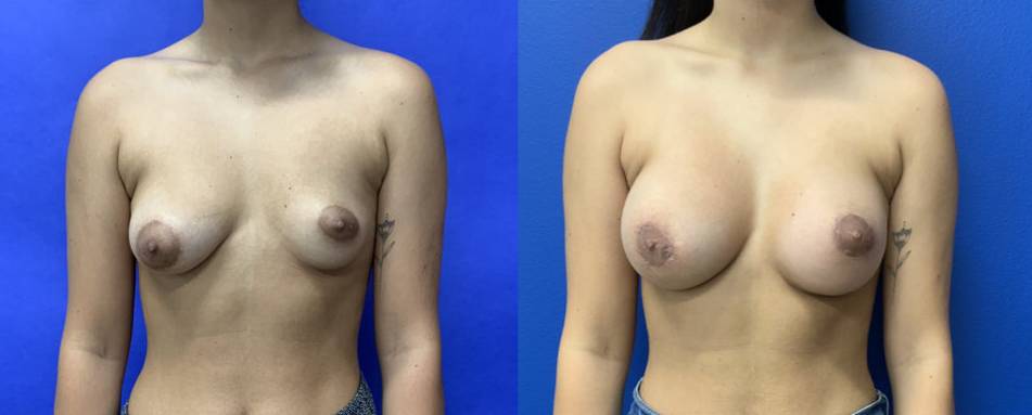 Before and After - Tuberous Breast