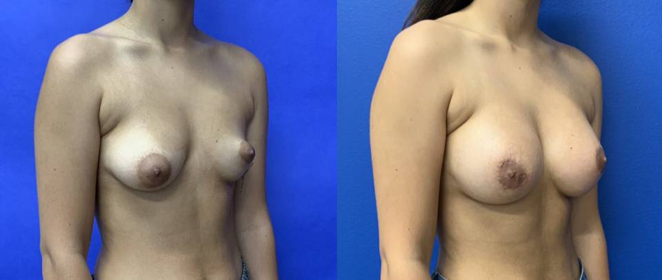 Before and After - Tuberous Breast