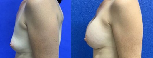 Before and After - Breast