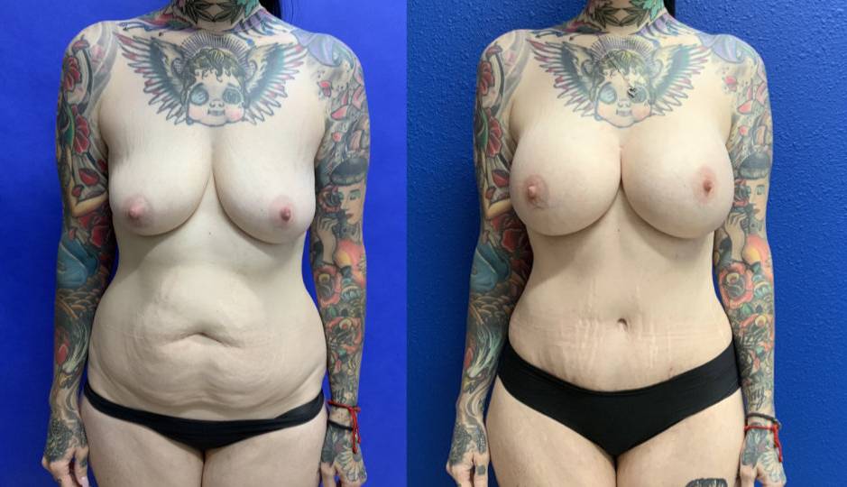 Before and After - Mommy Makeover