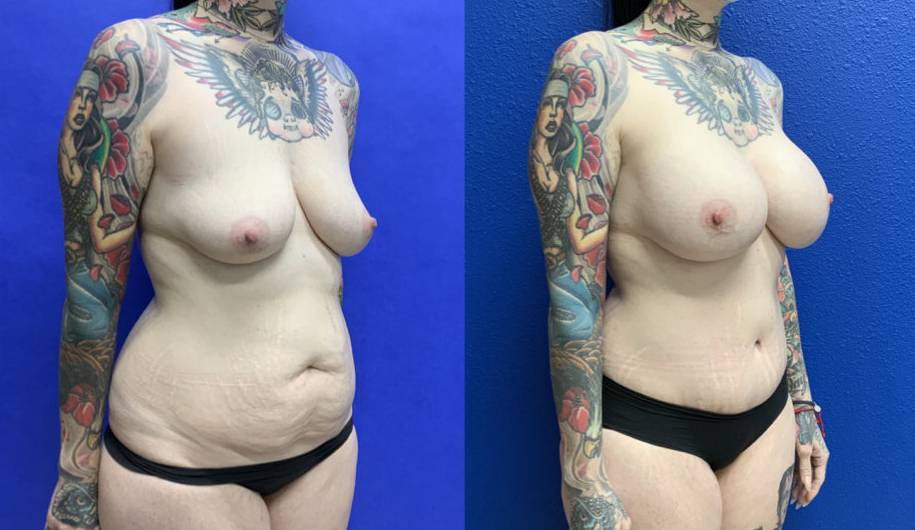 Before and After - Mommy Makeover