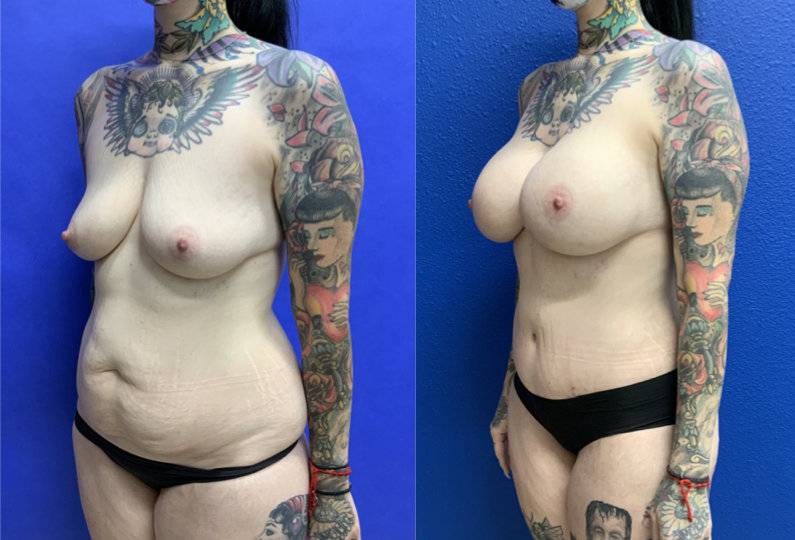 Before and After - Mommy Makeover