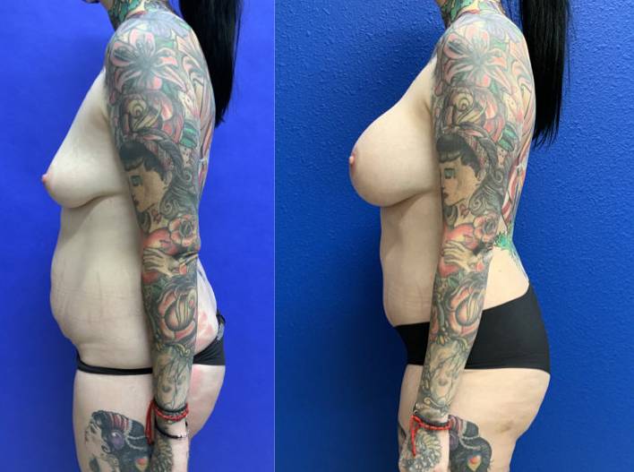Before and After - Mommy Makeover