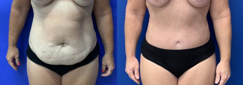 Before and After - Abdominoplasty