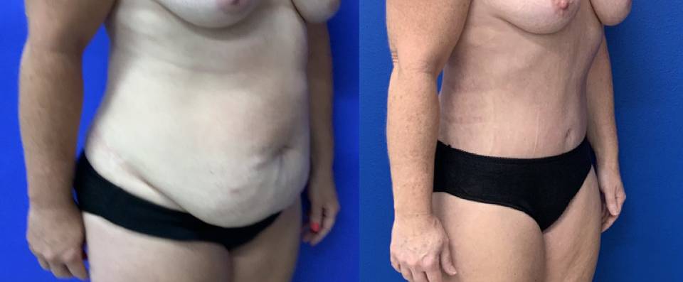 Before and After - Abdominoplasty