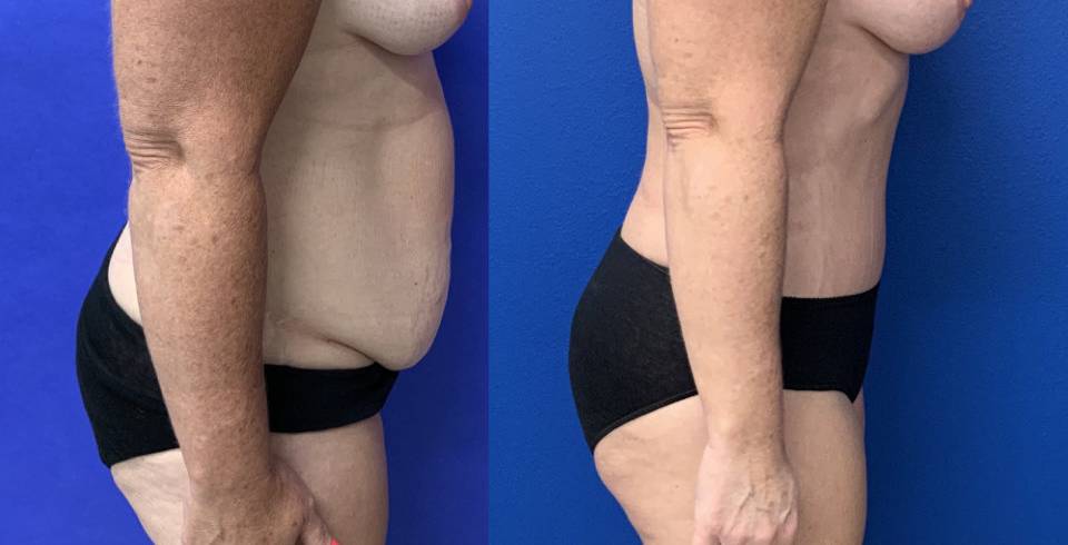 Before and After - Abdominoplasty