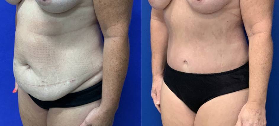 Before and After - Abdominoplasty