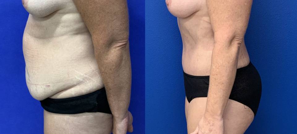 Before and After - Abdominoplasty