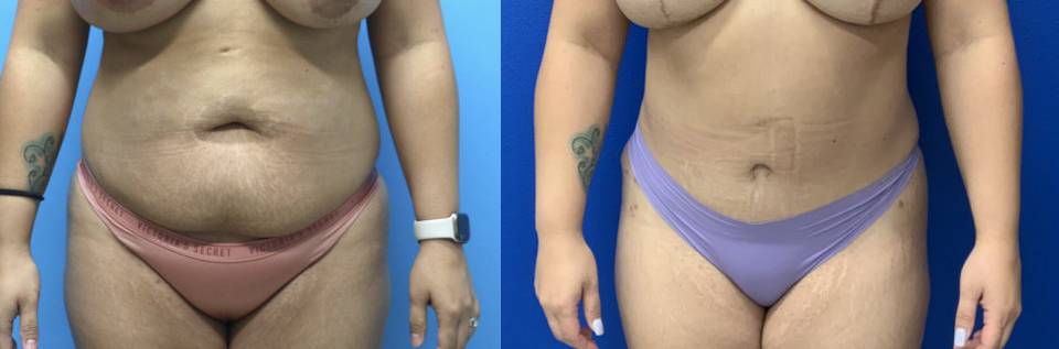 Before and After - Abdominoplasty