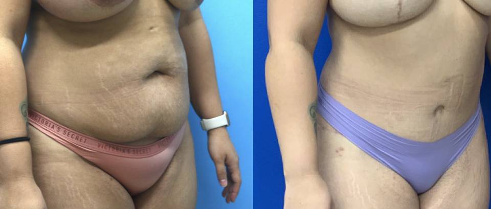 Before and After - Abdominoplasty