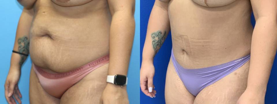Before and After - Abdominoplasty