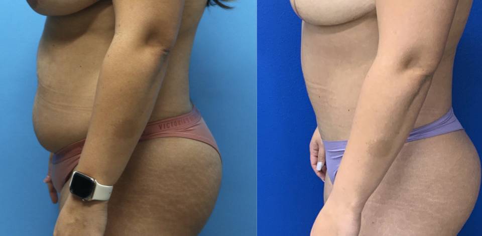 Before and After - Abdominoplasty