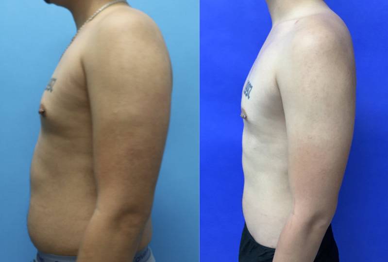 Before and After - Radiofrequency Assisted Liposuction