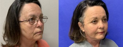 Before and After - Face