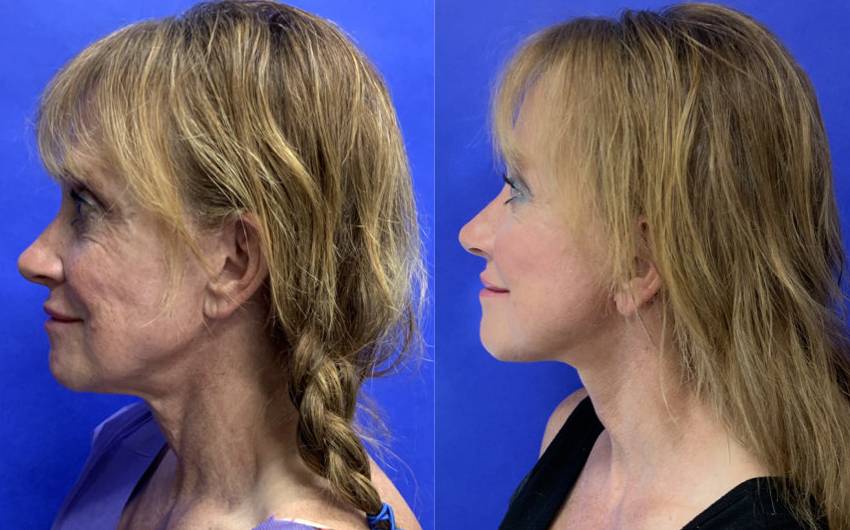 Before and After - Mini Face/Necklift