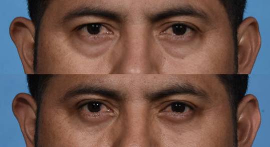 Before and After - Lower Blepheroplasty