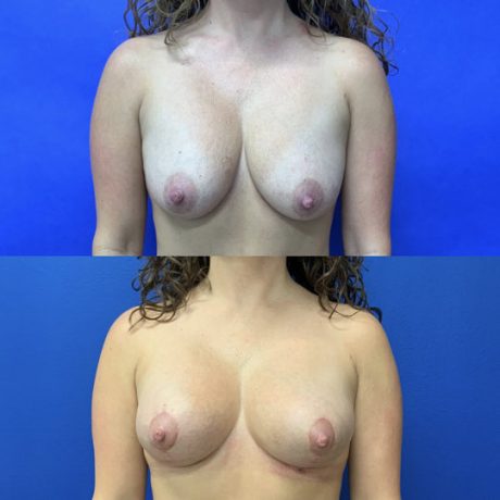 Before and After - Mini-Breast Lift