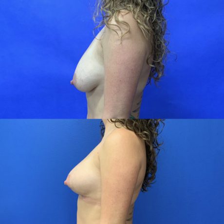 Before and After - Mini-Breast Lift