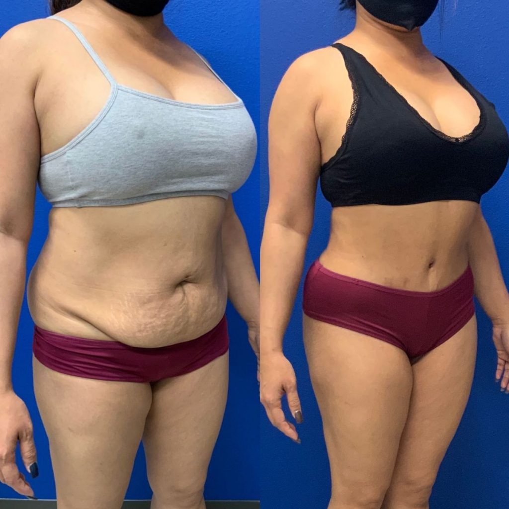 Before and After - Abdominoplasty