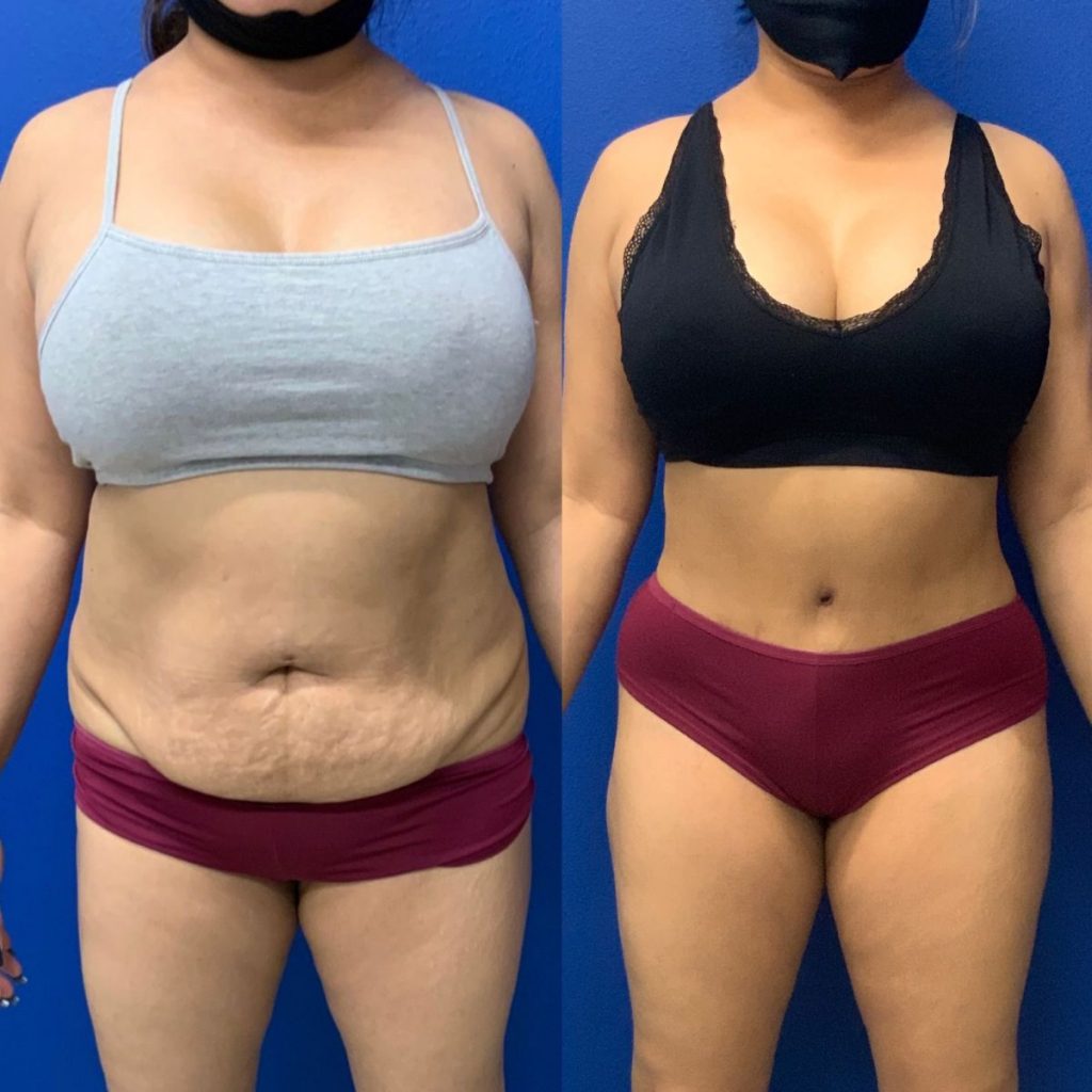 Before and After - Abdominoplasty