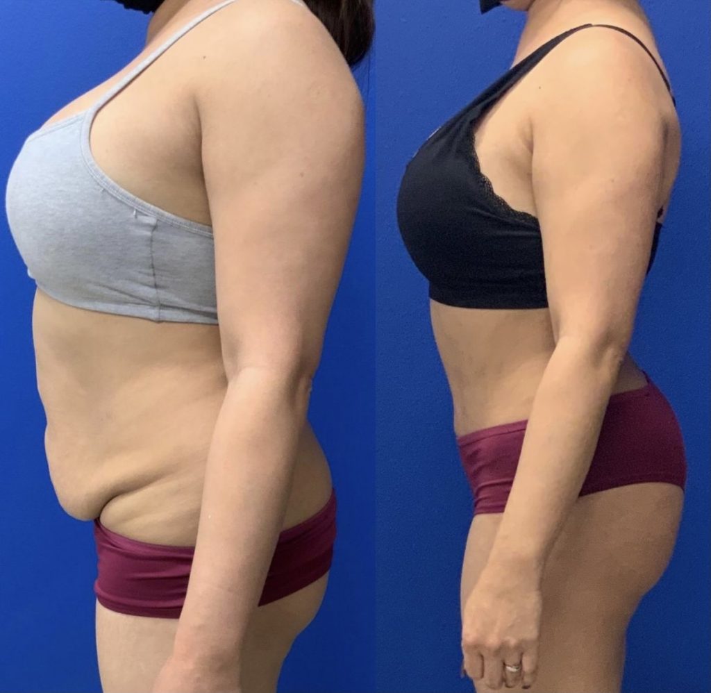 Before and After - Abdominoplasty
