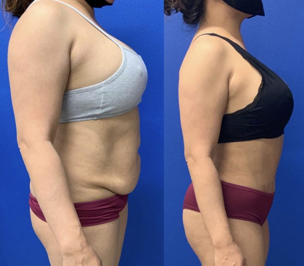 Before and After - Abdominoplasty