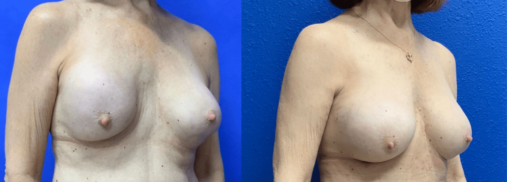 Before and After - Capsular contracture Correction