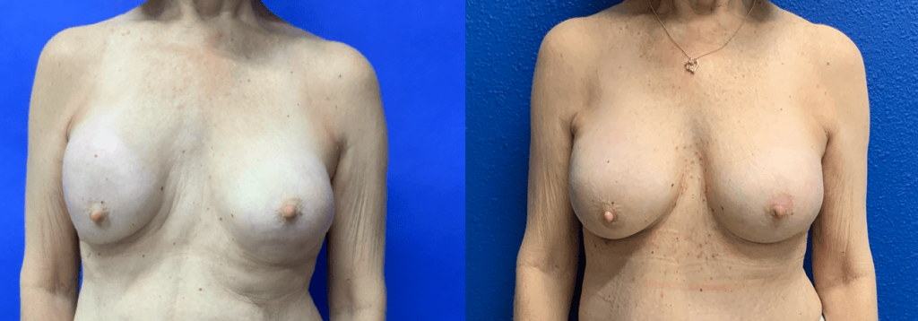 Before and After - Capsular contracture Correction