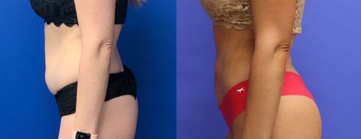 Before and After - Brazilian Buttlift