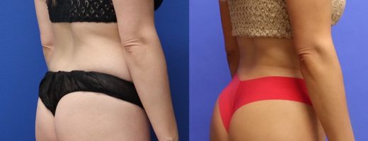 Before and After - Brazilian Buttlift