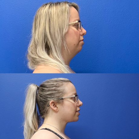 Before and After - Neck Liposuction with FaceTite Radiofrequency