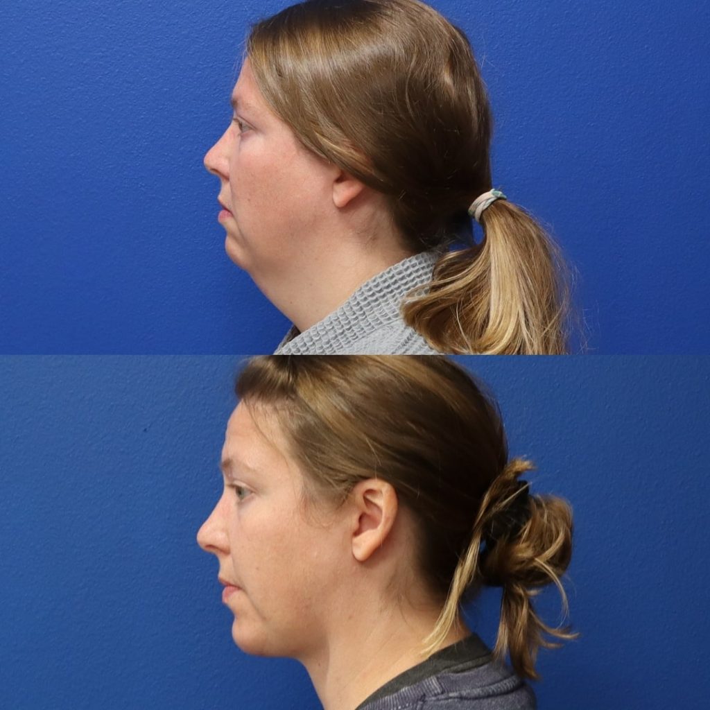 Before and After - Neck liposuction