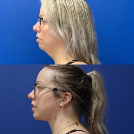 Before and After - Facial implants