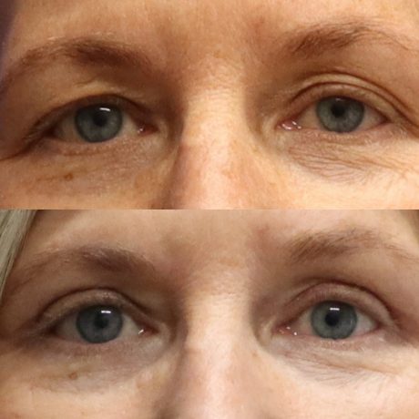 Before and After - Eyes