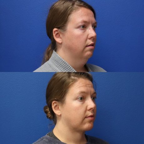 Before and After - Neck liposuction