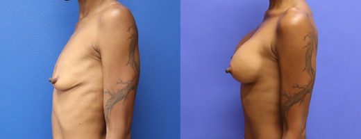 Before and After - Breast Augmentation