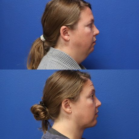 Before and After - Facial Implants