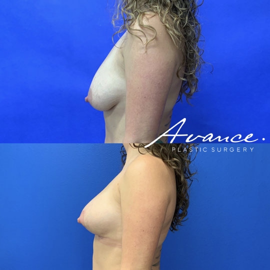 Before and After - Mini-Breast Lift